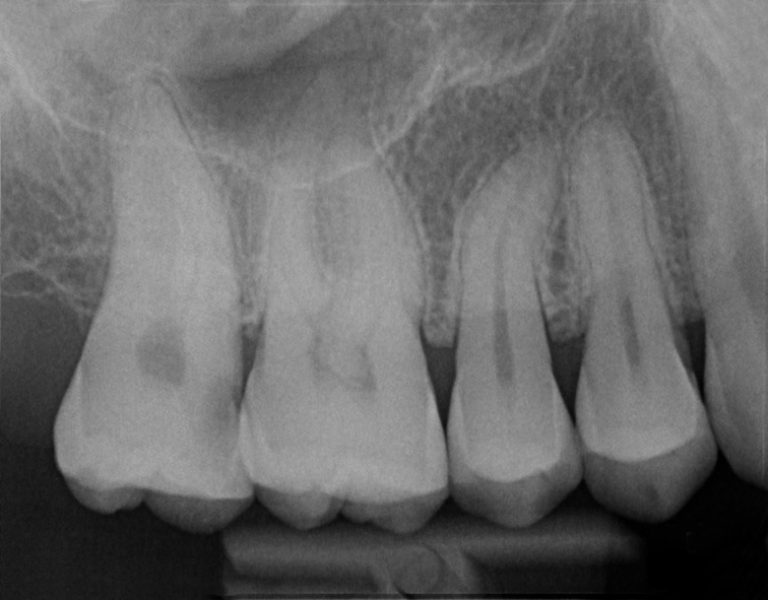 Endodonzia-radiografia-pre-operatoria - Dott.ssa Claudia Pallotta